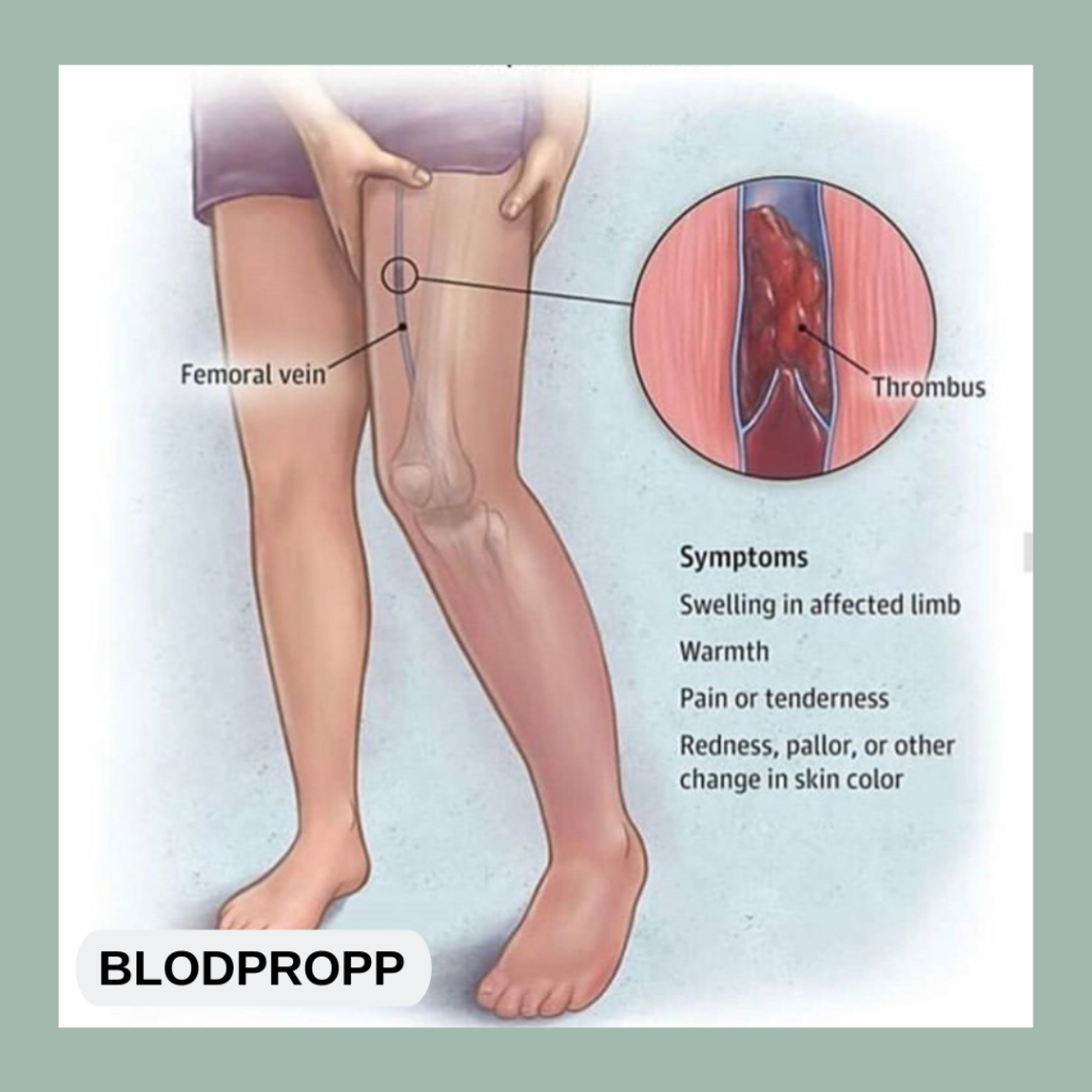 Blodpropp Symptomer Arm